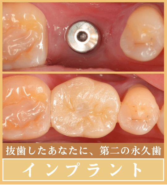 インプラント