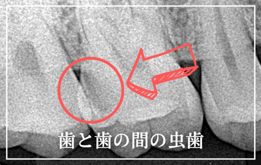 歯と歯の間の虫歯-タイトル