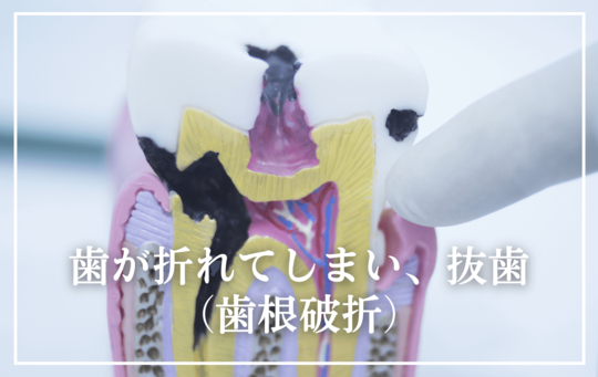 歯根破折-タイトル