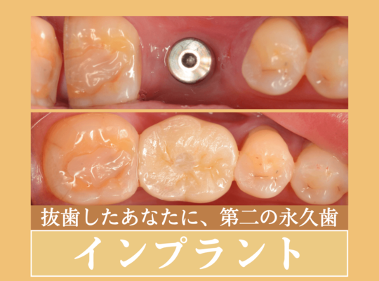 インプラント治療