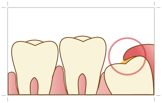 高円寺駅南口徒歩2分の歯医者、高円寺PAL歯科医院の口腔外科