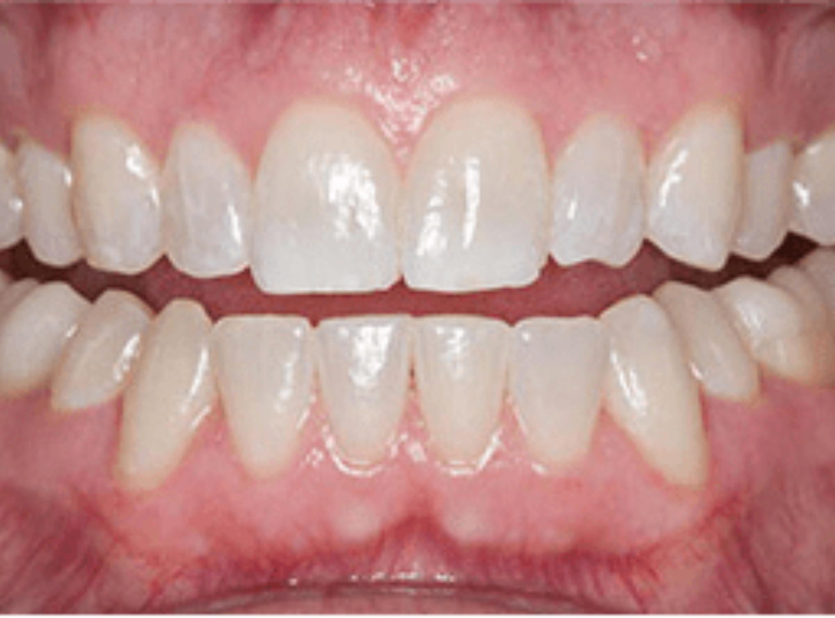 高円寺駅南口徒歩2分の歯医者、高円寺PAL歯科医院のインプラント治療の流れ