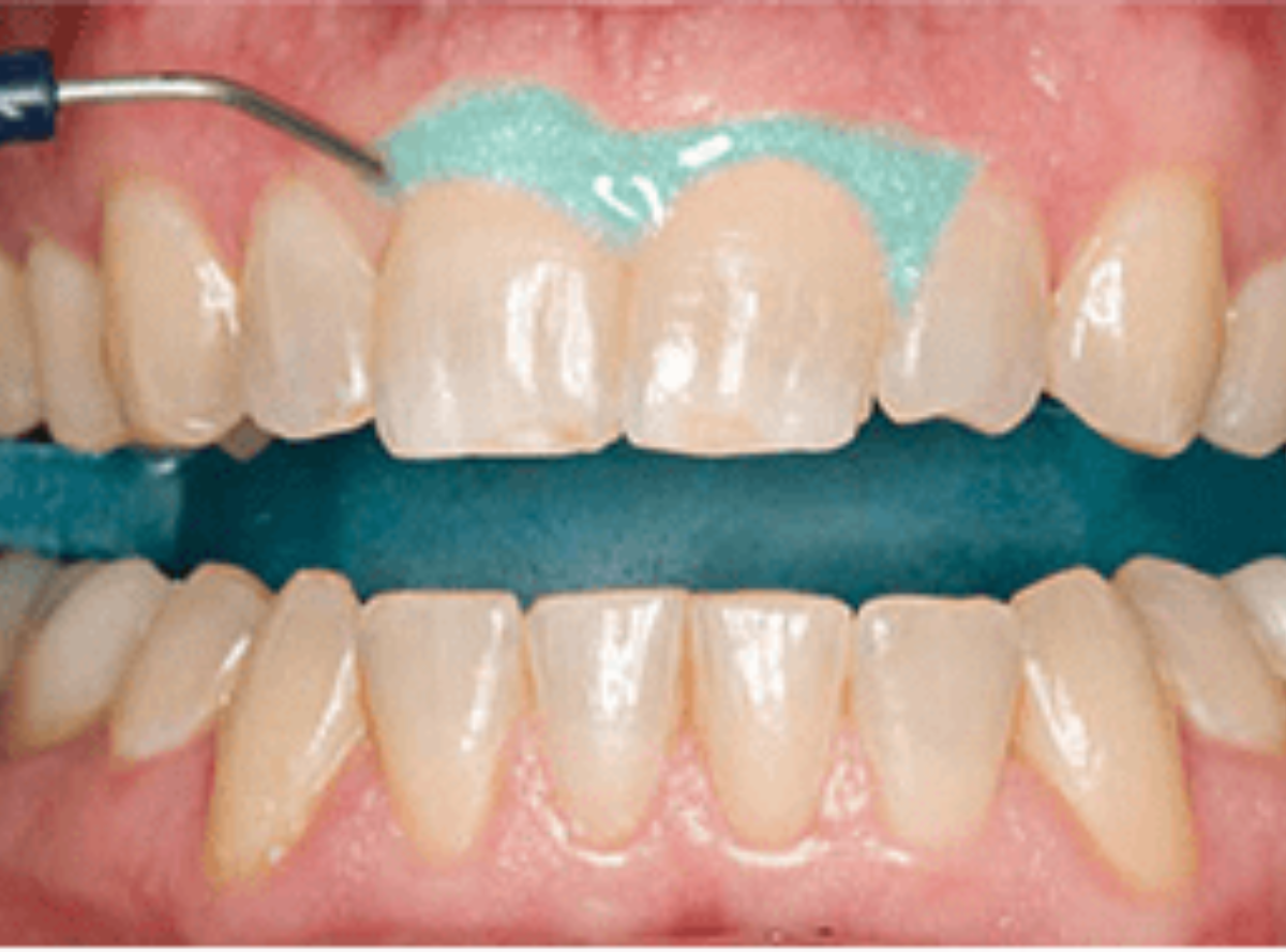 高円寺駅南口徒歩2分の歯医者、高円寺PAL歯科医院のインプラント治療の流れ