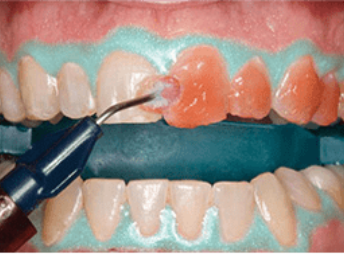 高円寺駅南口徒歩2分の歯医者、高円寺PAL歯科医院のインプラント治療の流れ