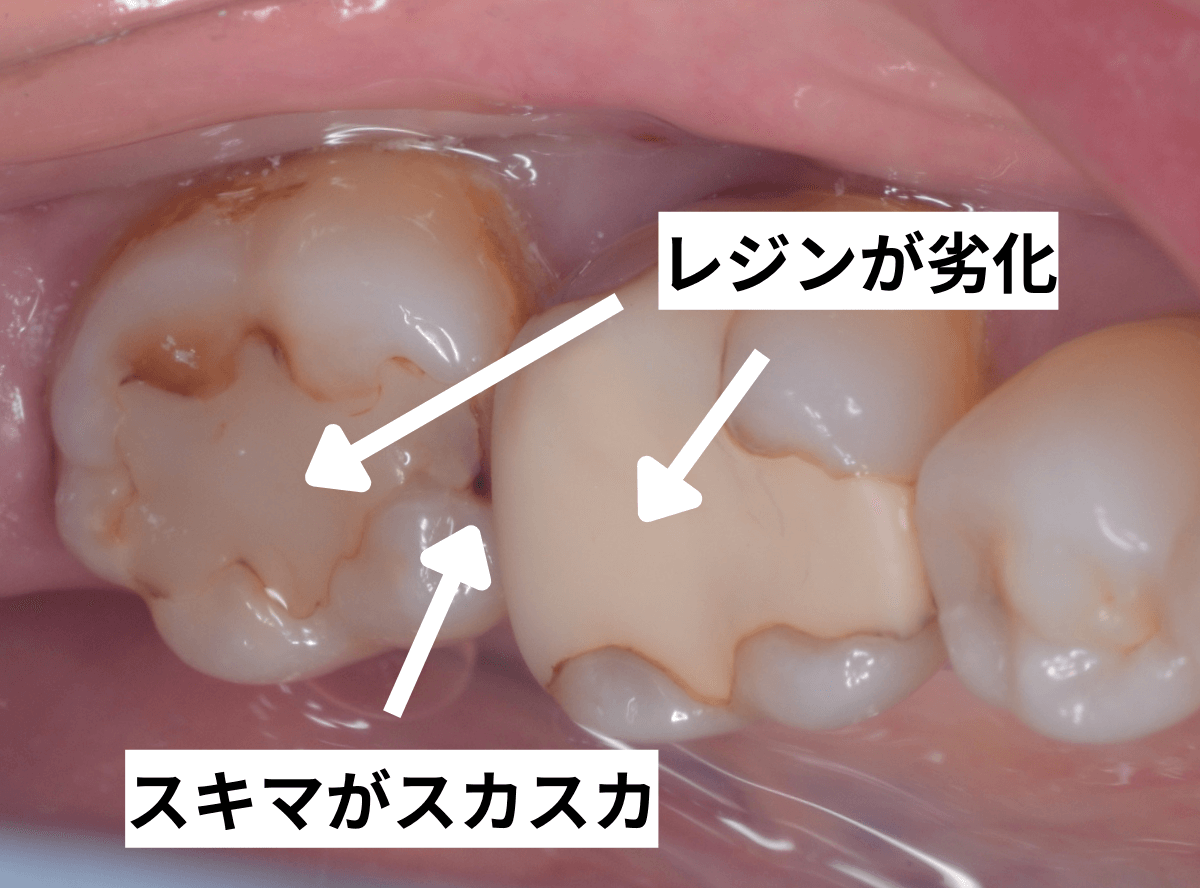 セラミック治療（インレー）8-2