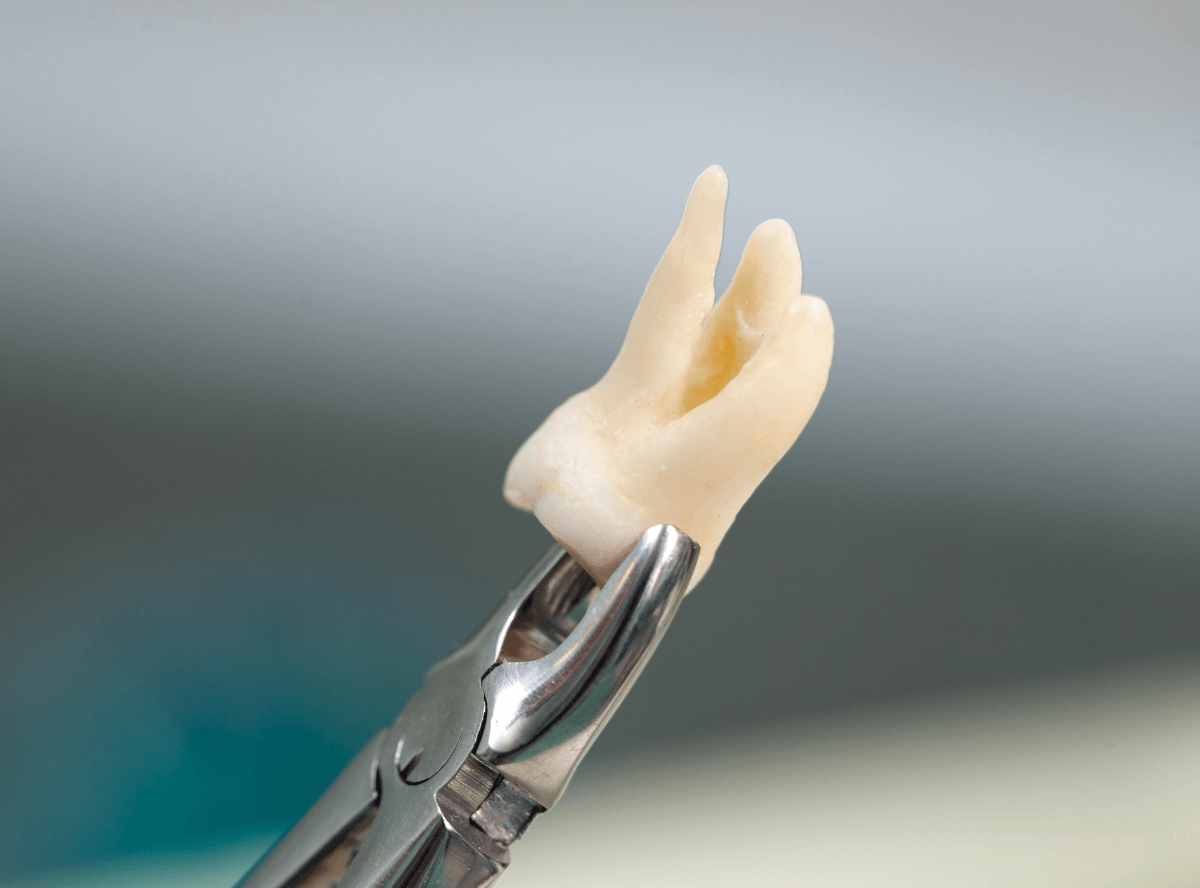 高円寺駅南口徒歩2分の歯医者、高円寺PAL歯科医院のインプラント治療の流れ