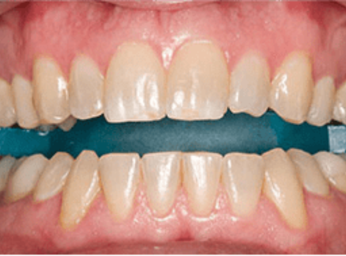 高円寺駅南口徒歩2分の歯医者、高円寺PAL歯科医院のインプラント治療の流れ